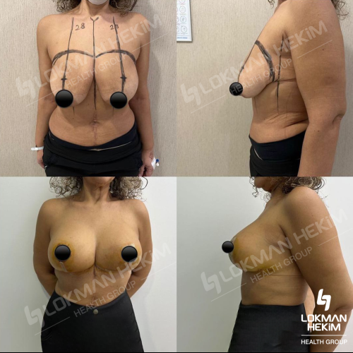 Абдоминопластика Фотографии до и после